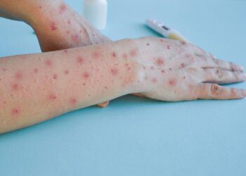 Beždžionių raupai Lietuvoje