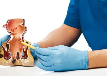 4 požymiai, kad hemorojus reikalauja medicininės intervencijos