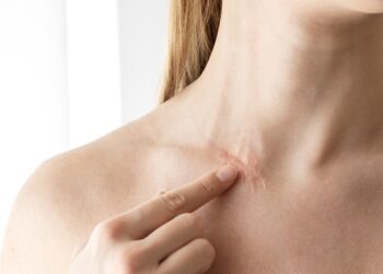 Efektyvus estetinis randų šalinimo būdas