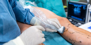 Venų varikozės operacija