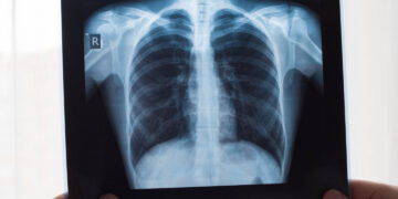 Plaučių rentgeno nuotrauka